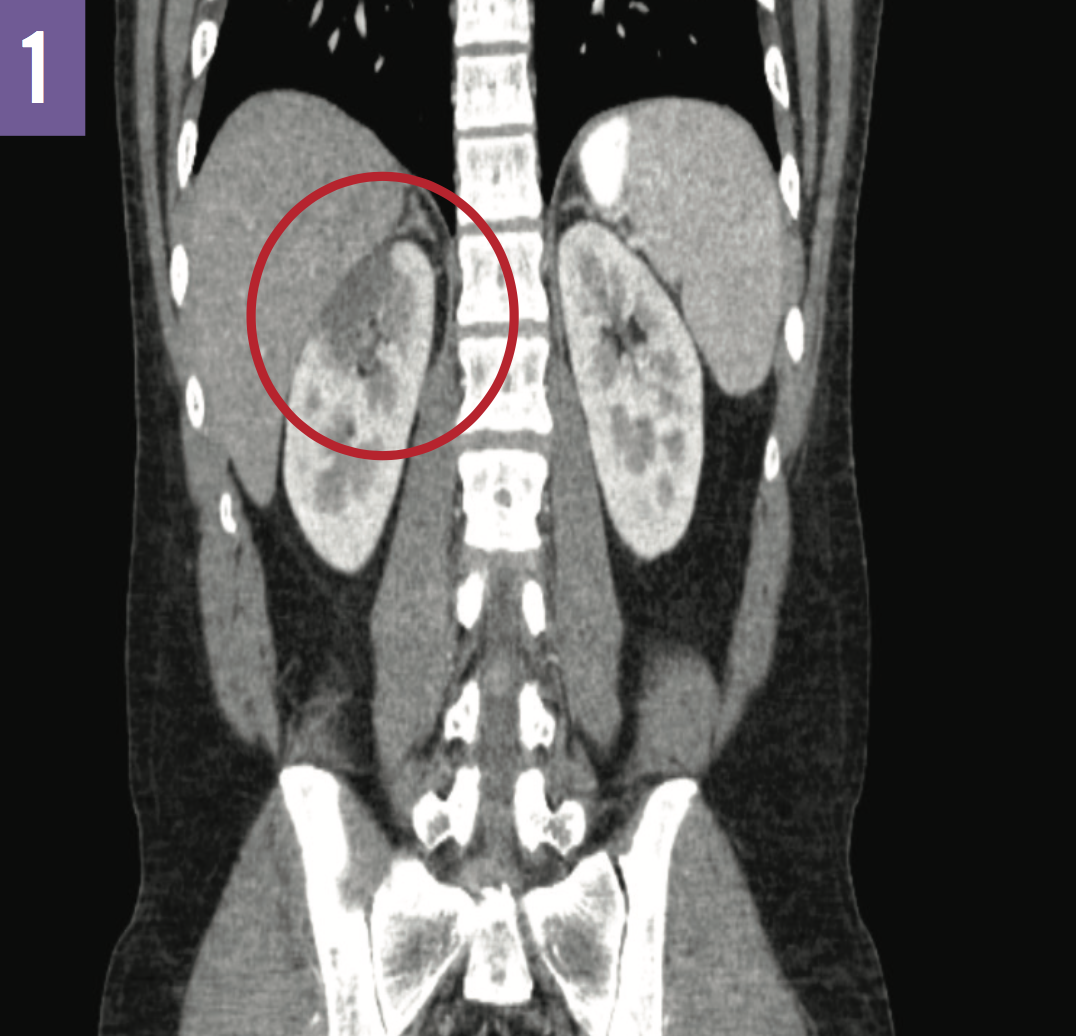 Renal Infarction in EhlersDanlos Syndrome Consultant360